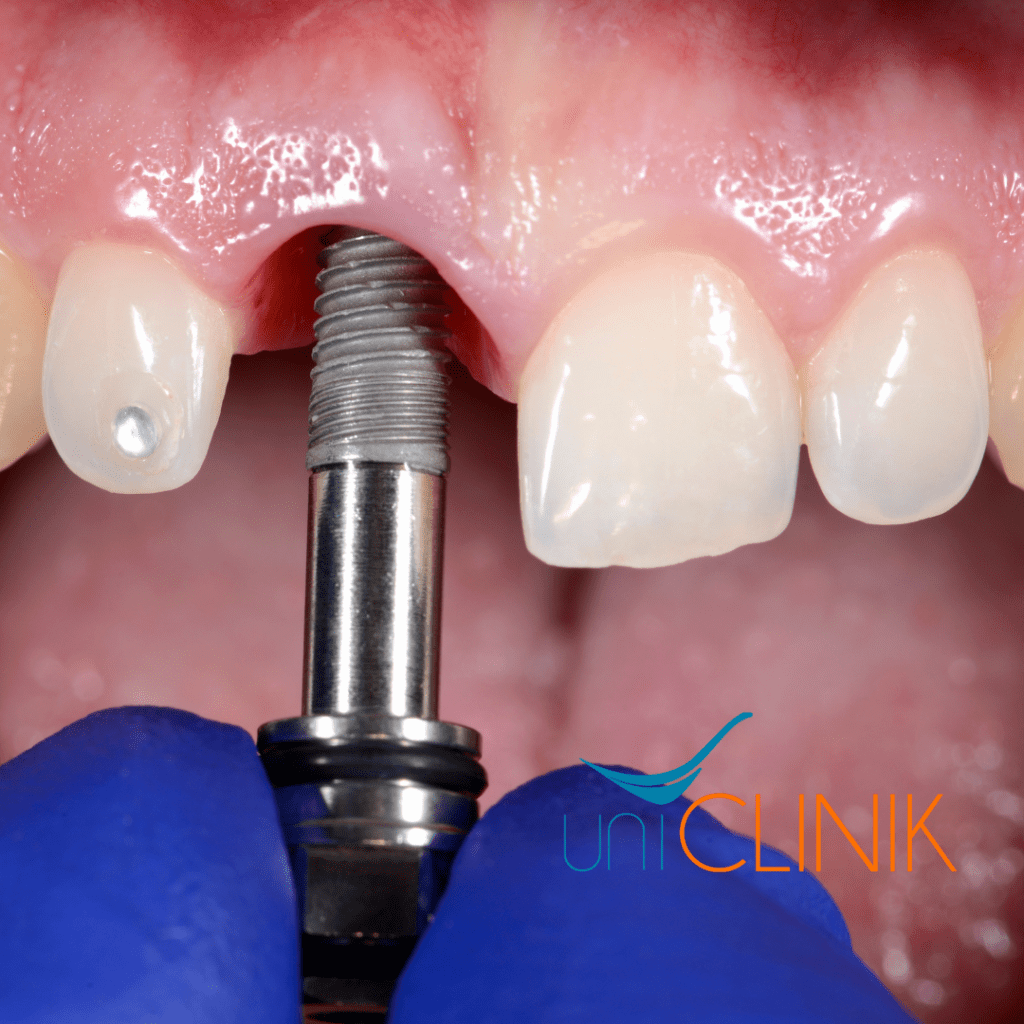 Implante dental